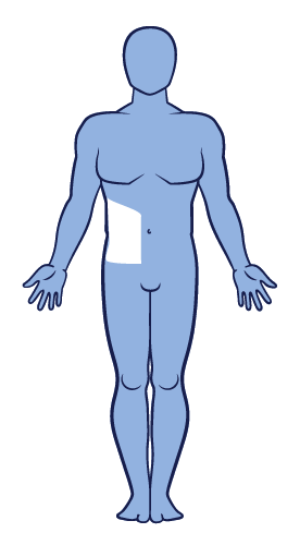 Segmental vitiligo